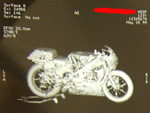 CT scan: motorcycle